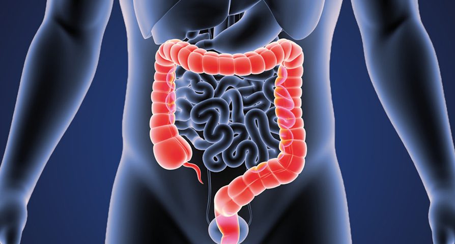 colorectal cancer | سرطان